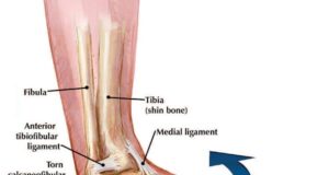 From Injury To Recovery: Understanding, Preventing, And Treating Common Sports Injuries
