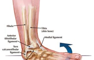 From Injury To Recovery: Understanding, Preventing, And Treating Common Sports Injuries