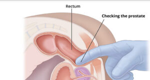Inflammatory Prostatitis In Nigerian Athletes: What Every Sportsman Should Know