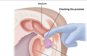 Inflammatory Prostatitis In Nigerian Athletes: What Every Sportsman Should Know