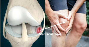 Knee Injuries On The Rise: What Athletes, Coaches Need To Know