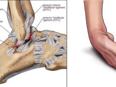 In Good Shape: What Every Nigerian Athlete Must Know About Ankle Strain