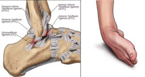 In Good Shape: What Every Nigerian Athlete Must Know About Ankle Strain
